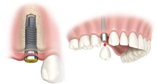 Despre Cris Smile si problema mea cu implant dentar